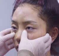 自體脂肪隆鼻、墊下巴、豐蘋(píng)果肌前后對(duì)比圖和恢復(fù)過(guò)程分享