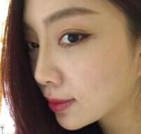 自體脂肪隆鼻、墊下巴、豐蘋(píng)果肌前后對(duì)比圖和恢復(fù)過(guò)程分享