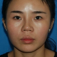 隆鼻失敗修復(fù)后果自然宛若天生