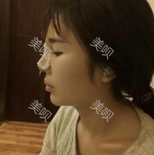 隆鼻失敗修復(fù)后果自然宛若天生