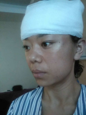 電波l皮緊膚手術(shù)過程及前后對(duì)比照片