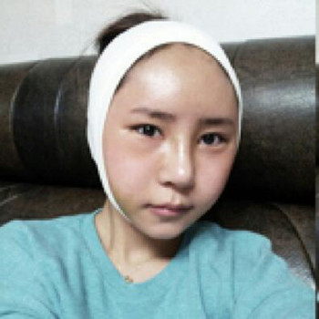 隆鼻整形手術(shù)讓我的小塌鼻變得挺拔娟秀