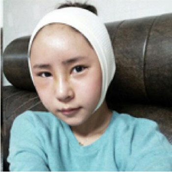 隆鼻整形手術(shù)讓我的小塌鼻變得挺拔娟秀