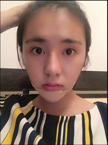 假體隆下巴讓我晉升女神行列