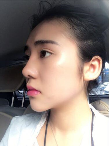 假體隆下巴讓我晉升女神行列