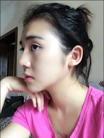 假體隆下巴讓我晉升女神行列