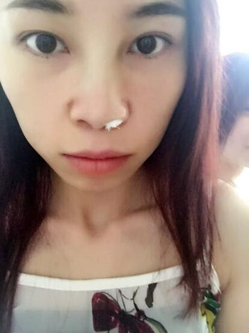 做了耳軟骨隆鼻手術(shù) 我真的真的有了高鼻梁
