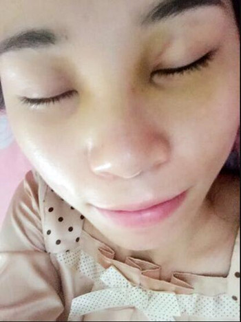 做了耳軟骨隆鼻手術(shù) 我真的真的有了高鼻梁