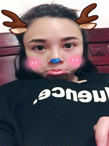 做了耳軟骨隆鼻手術(shù) 我真的真的有了高鼻梁