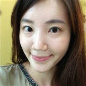 美女注射玻尿酸除皺過(guò)程分享，還有前后對(duì)比果圖片哦~