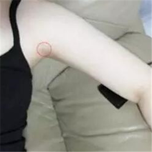 做了吸脂瘦手臂四個(gè)月，果很自然，有恢復(fù)前后對(duì)比果圖片哦~