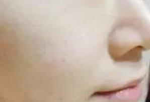 白瓷娃娃緩解一次后,皮膚能直觀看出來水潤(rùn)白皙緊致了一些