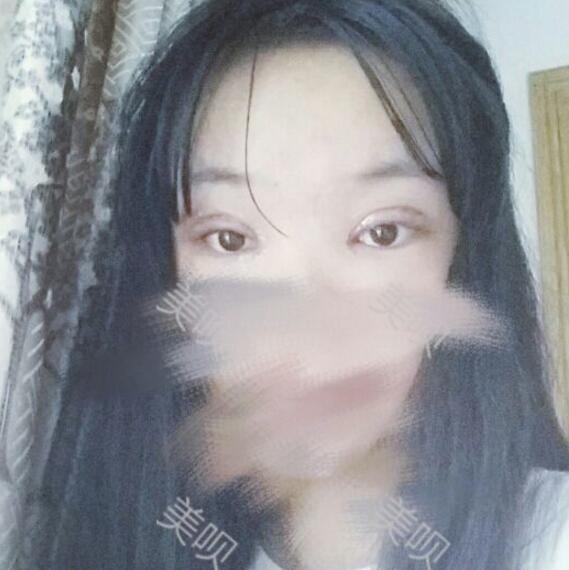 給大家分享下我割雙眼皮的恢復(fù)全過程希望對大家有幫助