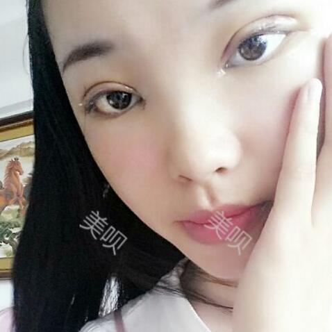 給大家分享下我割雙眼皮的恢復(fù)全過程希望對大家有幫助