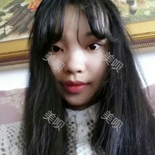 給大家分享下我割雙眼皮的恢復(fù)全過程希望對大家有幫助