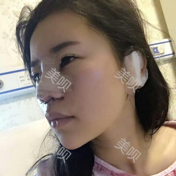 我的綜合隆鼻半個月的恢復(fù)歷程