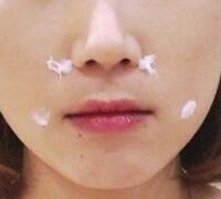 注射玻尿酸除皺價(jià)格3600元，術(shù)后果分享
