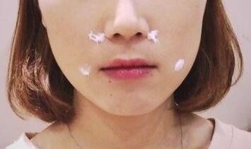 玻尿酸除皺