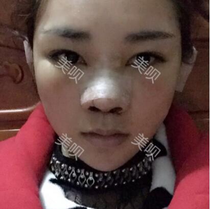 給大家分享在長(zhǎng)沙鵬愛做的膨體隆鼻近一個(gè)月的恢復(fù)過程