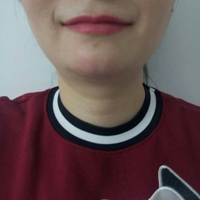 玻尿酸墊下巴后改變了我的大餅?zāi)樄镣淄椎? /> </a>
										<a href=