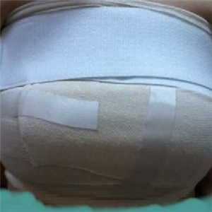 自體脂肪隆胸四個(gè)月了，曬一下恢復(fù)過(guò)程和前后對(duì)比果圖片~