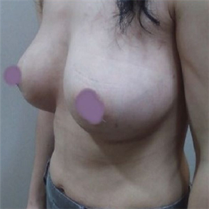 自體脂肪隆胸四個(gè)月了，曬一下恢復(fù)過(guò)程和前后對(duì)比果圖片~