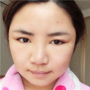 磨骨磨下頜角半年了，分享恢復(fù)過(guò)程和前后對(duì)比果照片哦~
