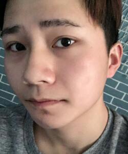 注射注射瘦臉B****恢復圖
