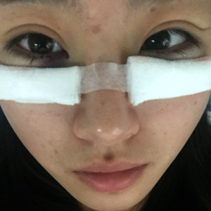 祛眼袋半年了，曬曬我的恢復前后對比果圖片哦