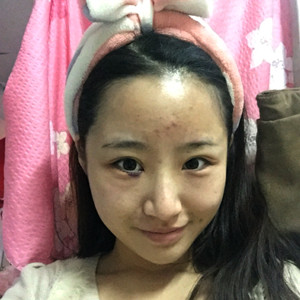 祛眼袋半年了，曬曬我的恢復前后對比果圖片哦