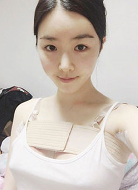 假體隆胸手術(shù)恢復過程分享，還有前后對比照片哦