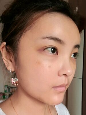 自體脂肪面部填充之后飽滿又自然，廣州曙光劉永波做噠