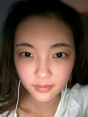 自體脂肪面部填充之后飽滿又自然，廣州曙光劉永波做噠