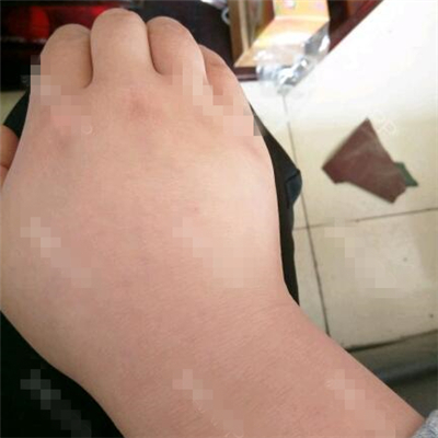 做了副乳吸脂手術(shù)半年了，分享前后對(duì)比果圖片~