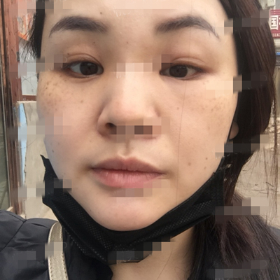 面部奧美定取出手術(shù)前后對比果圖片分享，銅雀臺做的呢~