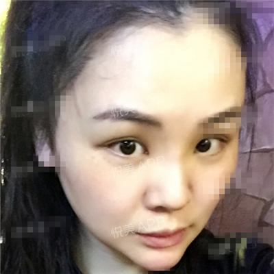 面部奧美定取出手術(shù)前后對比果圖片分享，銅雀臺做的呢~