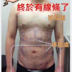 吸脂減肥手術(shù)瘦身，也算一個正能量胖子逆襲的故事吧