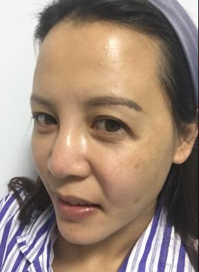 蛋白埋埋蛋白線(xiàn).提升手術(shù)前照片