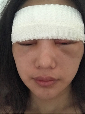 自體脂肪隆眉弓后，更有精神了