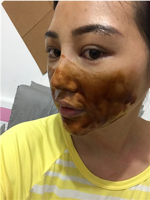 自體脂肪隆眉弓后，更有精神了