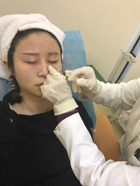 記錄了玻尿酸填充淚溝手術(shù)前后過程，還有前后對比圖哦