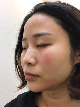 記錄了玻尿酸填充淚溝手術(shù)前后過程，還有前后對比圖哦