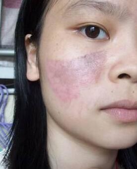 激光去痣圖片