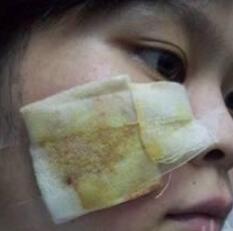 激光去胎記