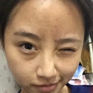 做了玻尿酸隆眉弓，感覺棒棒噠