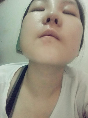 做了隆鼻整形手術(shù)，給大家分享一下手術(shù)過程，還有對比照片哦