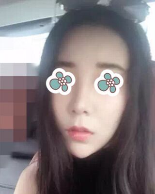 隆鼻失敗修復(fù)后整給鼻形很精致，鄭志敏醫(yī)生做的