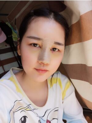 硅膠隆鼻+耳軟骨墊鼻尖后美到朋友認不出