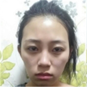 自體脂肪面部填充一年了，分享我的恢復(fù)過(guò)程，有前后對(duì)比照片哦~
