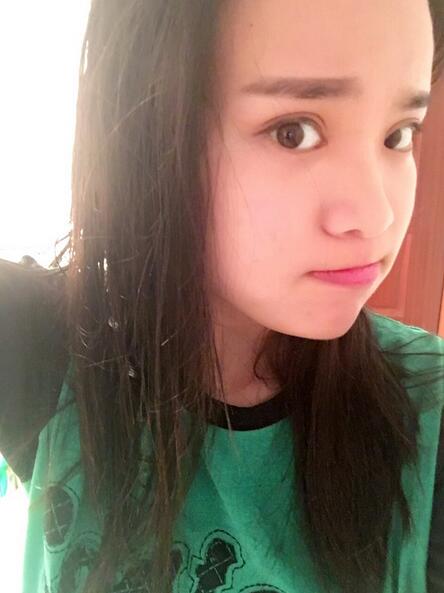 鄭州悅美切開雙眼皮半個(gè)月恢復(fù)日記